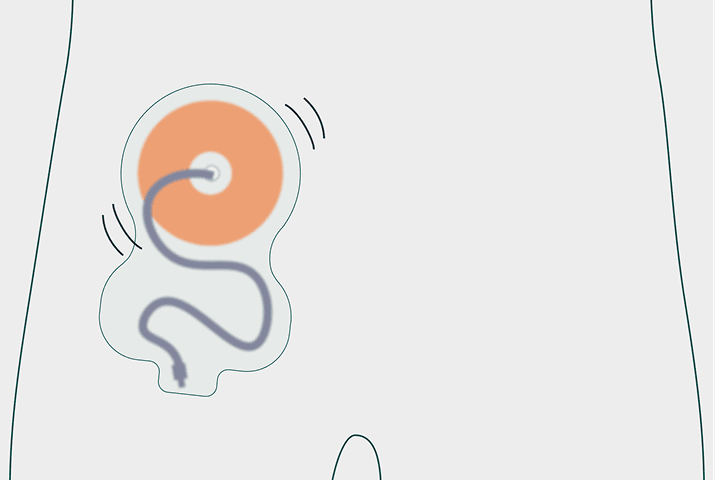 Adhesion